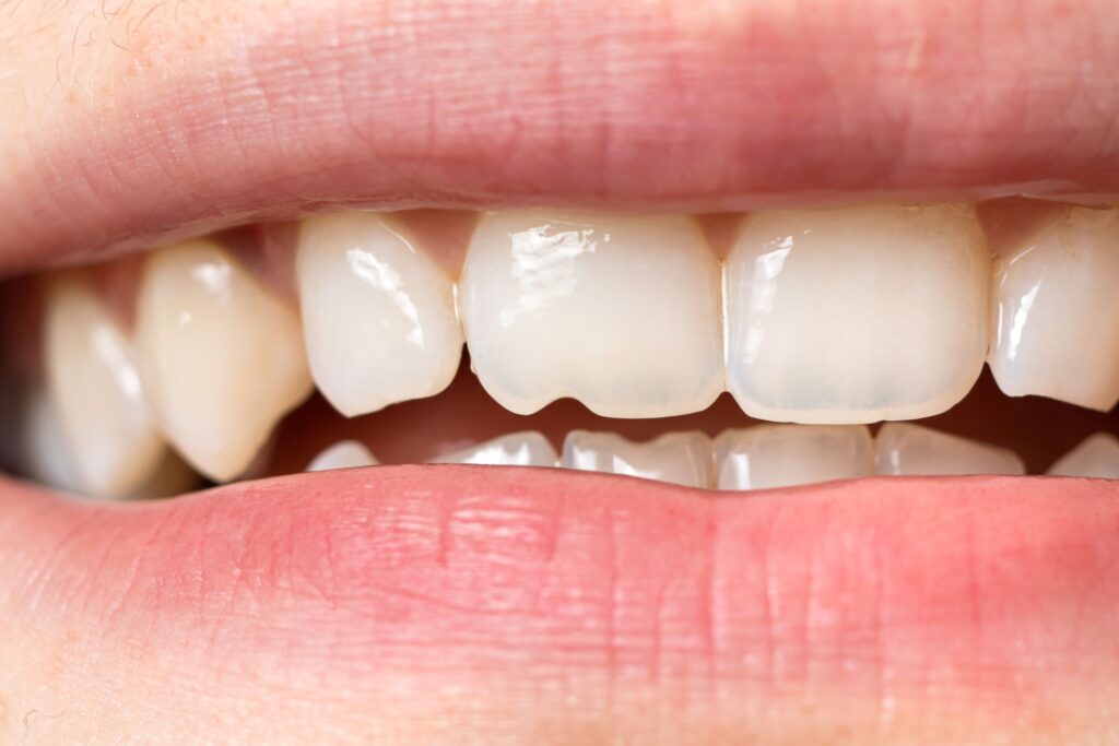 Closeup of a chipped front tooth